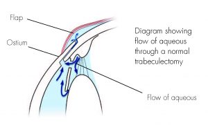Trabeculectomy image